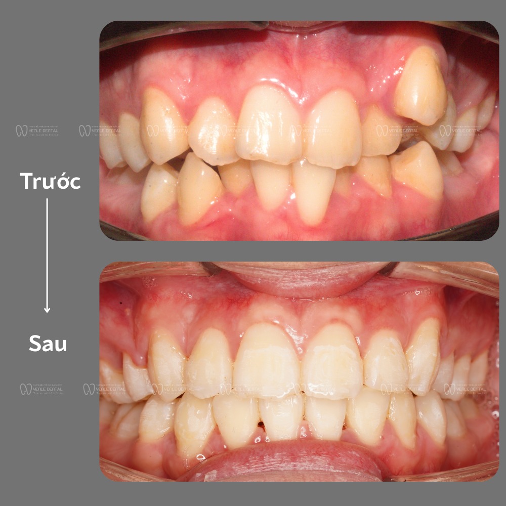 Có nên niềng răng không?